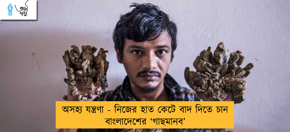 অসহ্য যন্ত্রণা - নিজের হাত কেটে বাদ দিতে চান বাংলাদেশের ‘গাছমানব’