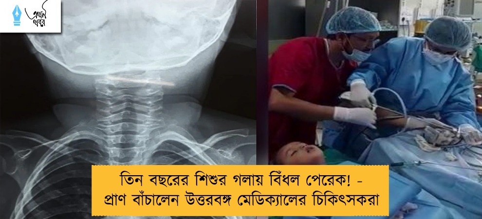 তিন বছরের শিশুর গলায় বিঁধল পেরেক! - প্রাণ বাঁচালেন উত্তরবঙ্গ মেডিক্যালের চিকিৎসকরা