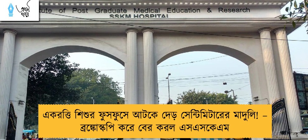 একরত্তি শিশুর ফুসফুসে আটকে দেড় সেন্টিমিটারের মাদুলি! – ব্রঙ্কোস্কপি করে বের করল এসএসকেএম