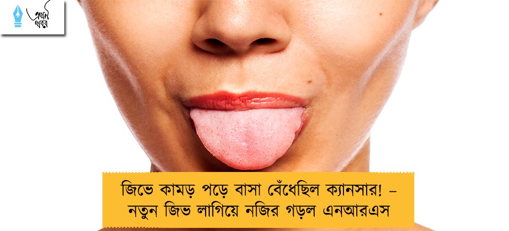 জিভে কামড় পড়ে বাসা বেঁধেছিল ক্যানসার! – নতুন জিভ লাগিয়ে নজির গড়ল এনআরএস