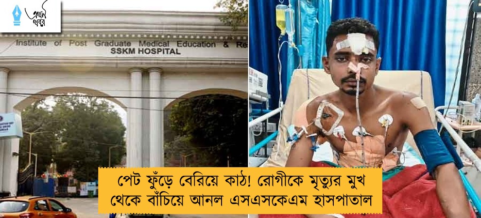 পেট ফুঁড়ে বেরিয়ে কাঠ! রোগীকে মৃত্যুর মুখ থেকে বাঁচিয়ে আনল এসএসকেএম হাসপাতাল